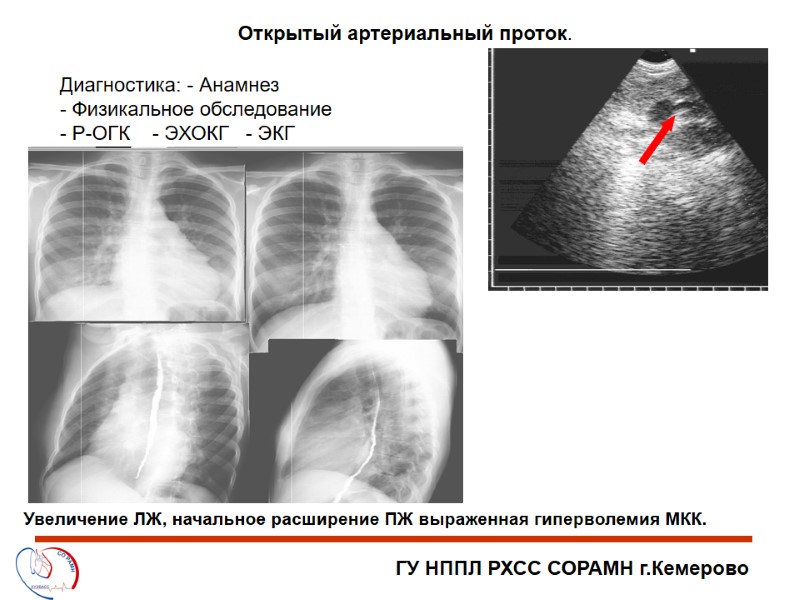 ГУ НППЛ РХСС СОРАМН г.Кемерово Открытый артериальный проток. Диагностика: - Анамнез  Физикальное обследование